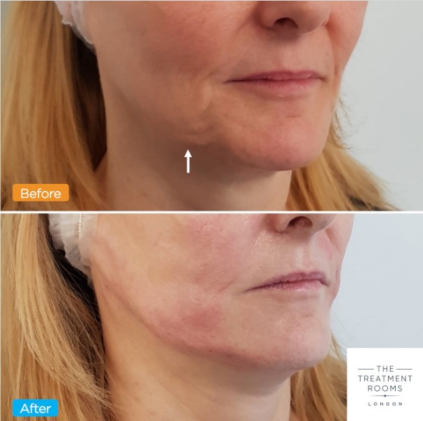 Jowl thread lift